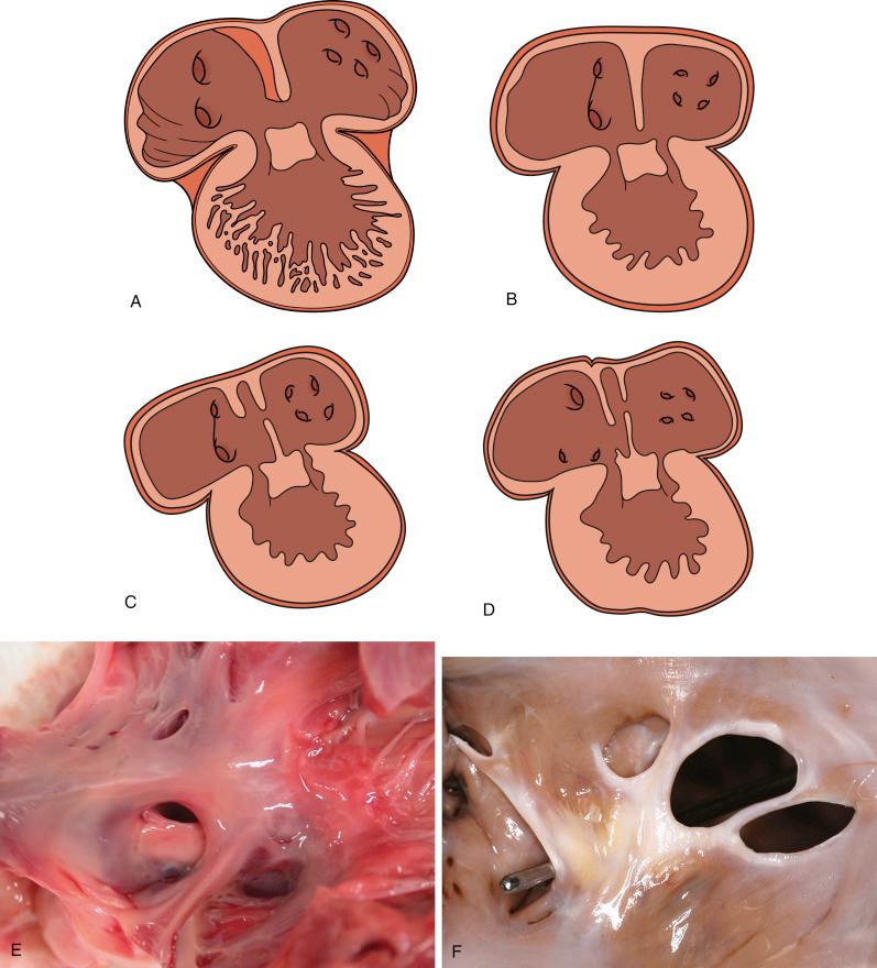 • eFig. 10.1, Development of the interatrial septum. A, View of the heart showing right and left atria and left ventricle with posterior atrioventricular cushion. The primary septum (septum primum) grows between the right and left atria. Its lower border grows towards the atrioventricular cushion, the gap between them forming the ostium primum ( B ).