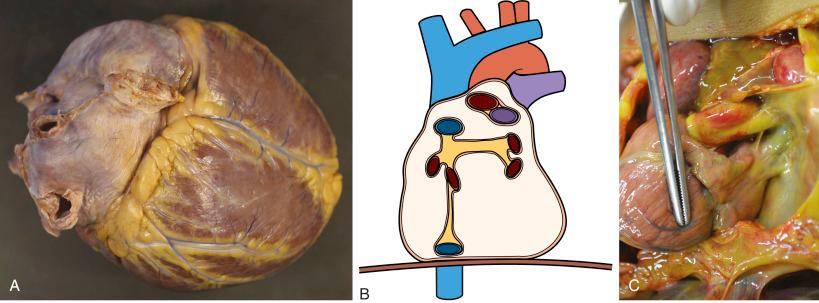 • eFig. 10.2, A, Posterior aspect of the heart. The heart is viewed from behind and has been tilted forward to expose part of the diaphragmatic surface. The ventricular myocardium is dark brown in contrast to the paler colour of the atrial myocardium. The atrioventricular groove separating the atria and the ventricles is marked by abundant adipose tissue. The right atrial appendage is at the top of the picture. In the centre is the inferior caval vein (the lumen of which is closed). The interatrial junction stretches horizontally to the left of the picture. The pulmonary veins are evident at the corners of the left atrium. Extending from the inferior caval vein to the pulmonary veins, the cut surface of the pericardial attachment can be seen. These attachments delimit the oblique sinus of the pericardium.