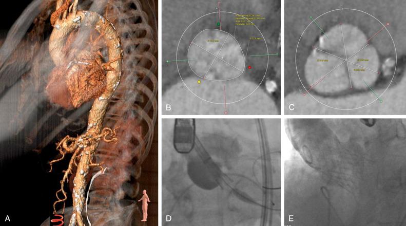 Fig. 54.2, Evolut-R 34 mm deployment for a large aortic annulus.