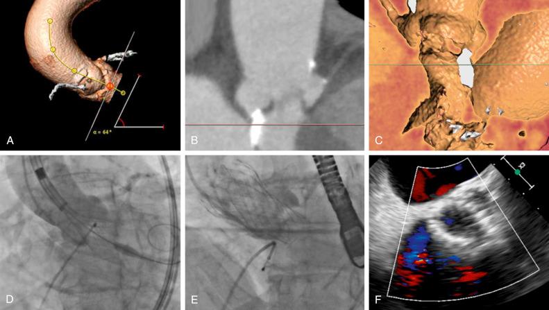 Fig. 54.3, Evolut PRO 29 mm deployment in a patient with extensive left ventricular outflow tract (LVOT) calcium.