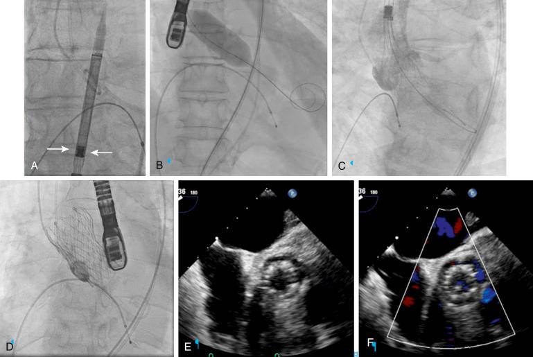 Fig. 54.5, Predilation due to valve calcification prior to self-expanding transcatheter aortic valve replacement.