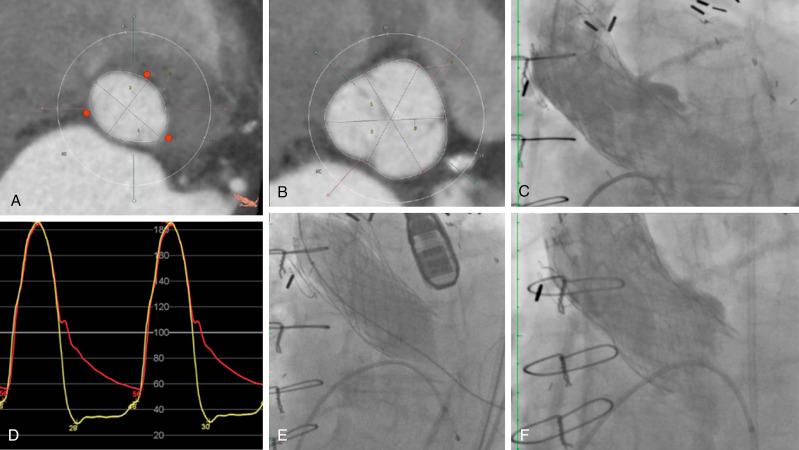 Fig. 54.6, Residual aortic regurgitation treated with balloon postdilation.
