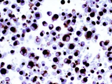 Fig 12, Sparsely granular GH-producing pituitary adenoma with fibrous bodies. Fibrous bodies are strongly immunoreactive for cytokeratins (CAM5.2).