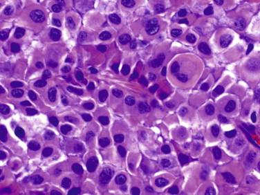 Fig 13, Crooke's cell pituitary adenoma. Tumor cells contain perinuclear eosinophilic material (“Crooke's hyaline”) and may show variable degrees of cytologic atypia.