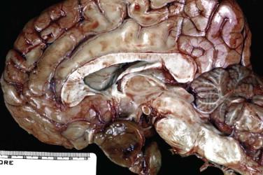 Fig 2, Pituitary adenoma. This gross sagittal section shows a large soft tan-brown adenoma ( bottom center ).