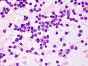 Fig 3, Pituitary adenoma. On touch preparation, a monomorphous population of discohesive cells is typical.