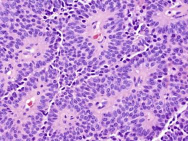 Fig 5, Pituitary adenoma. Among the variations in histology known to occur with this tumor, a perivascular pseudorosette-like appearance may be prominent and could mimic an ependymoma.