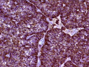 Fig 6, Pituitary adenoma. Chromogranin is typically immunoreactive in the tumor cells.