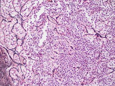 Fig 7, Pituitary adenoma. Reticulin stain is useful to distinguish the normal lobular pituitary gland architecture ( left ) from the adenoma ( remainder of image ), which shows dispersal of reticulin material.