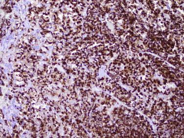 Fig 8, Pituitary adenoma. This tumor (same as the one shown in Figure 7 ) shows strong prolactin immunoreactivity.