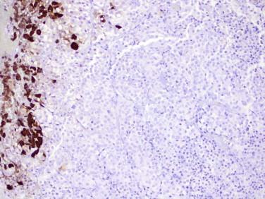 Fig 9, Pituitary adenoma. A serial section of the adenoma shown in Figures 7 and 8 shows ACTH-immunoreactive cells of the native pituitary gland ( left ), but the tumor ( rest of image ) is negative.