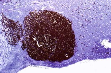 Fig 10, Pituitary microadenoma. This low-magnification photomicrograph shows a microadenoma that is strongly and diffusely immunoreactive for ACTH.