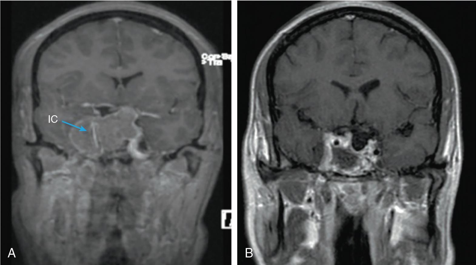 Fig. 31.1, A 21-year-old patient with a large suprasellar pituitary adenoma invading the cavernous sinus. Notice the compressed right internal carotid artery (IC) with reduced flow ( A ). Magnetic resonance imaging scan 2 days postoperatively shows complete removal of the pituitary adenoma ( B ). Dissolvable material with air is seen in the empty sella cavity.