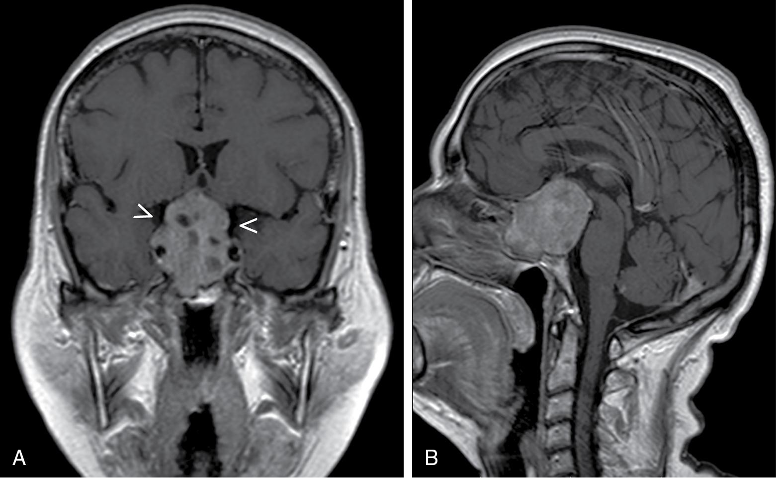 Fig. 31.2, A 45-year-old male patient with a large pituitary adenoma. The arrows in A show where the adenoma extends passed the diaphragma sella. B , Saggital view of the same patient.