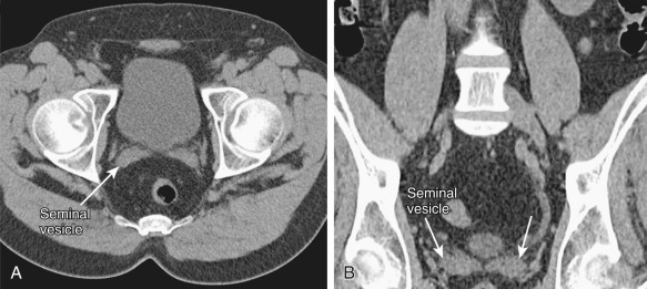 Figure 74-2, A and B, On computed tomography the seminal vesicles are of soft tissue attenuation and form a “bow-tie” appearance posterior to the prostate.