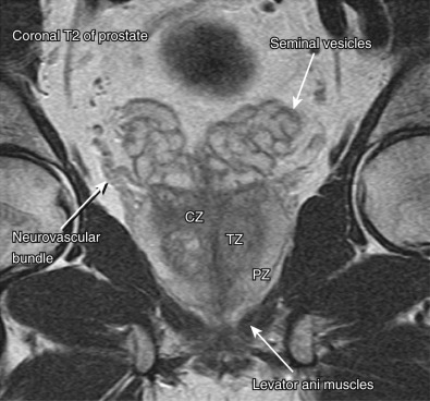 Figure 74-3, The paired seminal vesicles are perched posterolateral and superior to the prostate gland as seen on this T2-weighted coronal image demonstrating superior soft tissue contrast resolution. CZ, Central zone; PZ, peripheral zone; TZ, transitional zone.