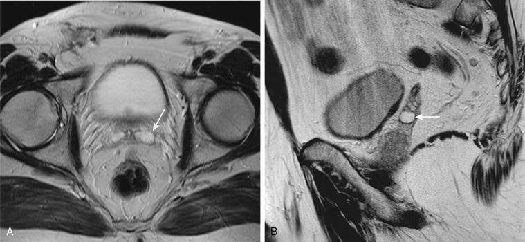 Figure 74-4, Axial (A) and sagittal (B) T2-weighted magnetic resonance images demonstrate a left seminal vesicle cyst (arrows). Seminal vesicle cysts manifest as a mass between the rectum and base of the bladder and may be associated with ejaculatory duct dilation. They are usually unilateral and unilocular and resemble dilated seminal vesicles.