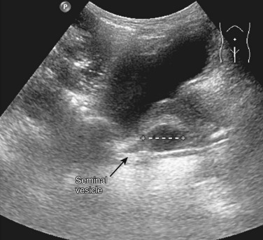 Figure 74-5, Ultrasound image of a seminal vesicle cyst.
