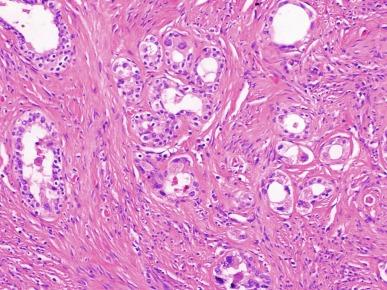 Fig. 10.1, Tangential needle biopsy through the seminal vesicles, which may be mistaken for adenocarcinoma.