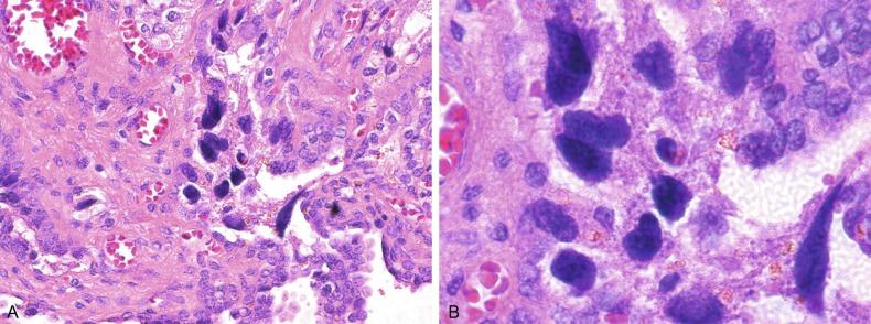 Fig. 10.2, Seminal vesicle from an 80-year-old man that shows distinctive highly atypical epithelial cells. (A) low power. (B) oil immersion.