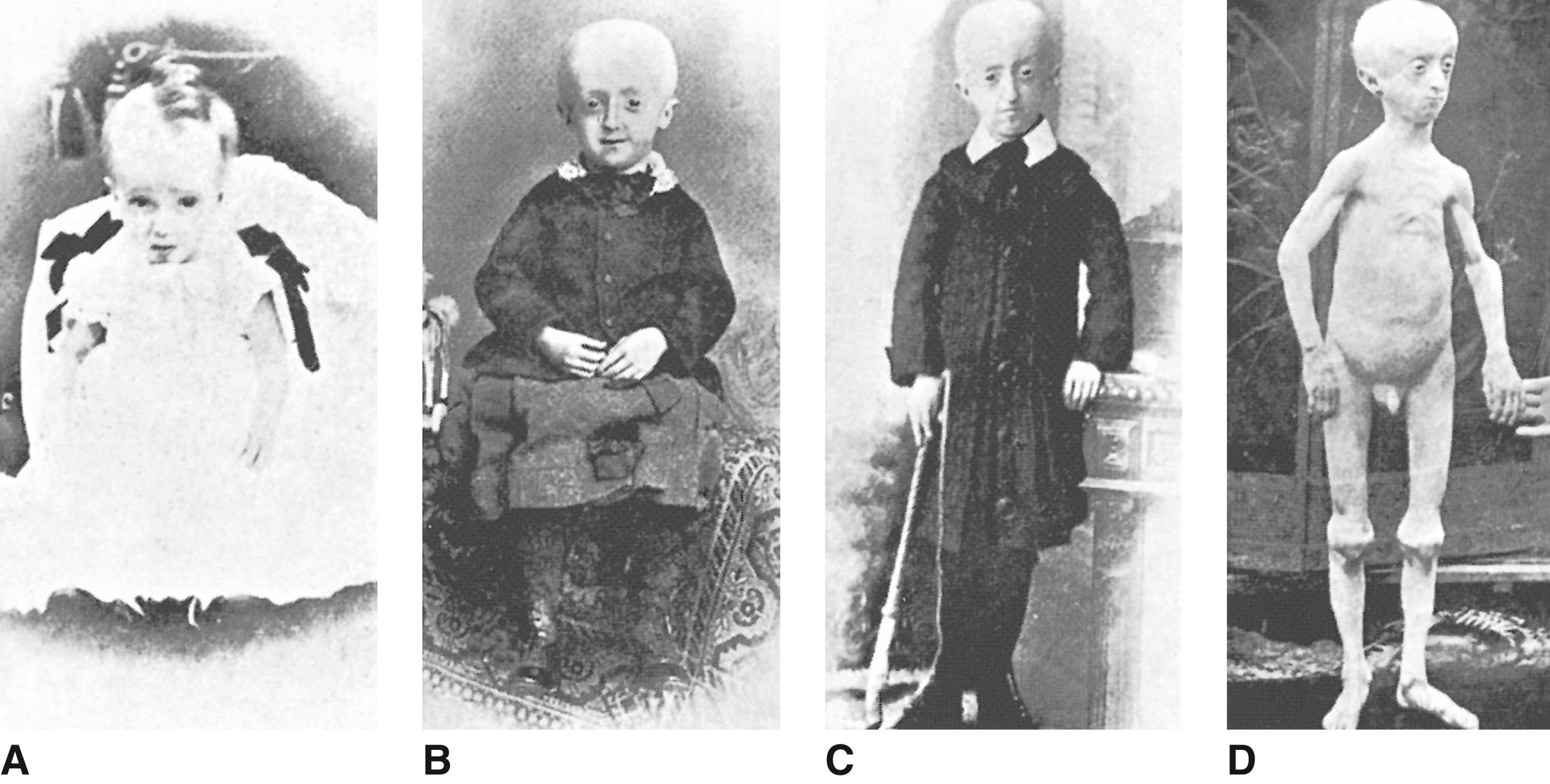 FIGURE 1, Progeria syndrome.