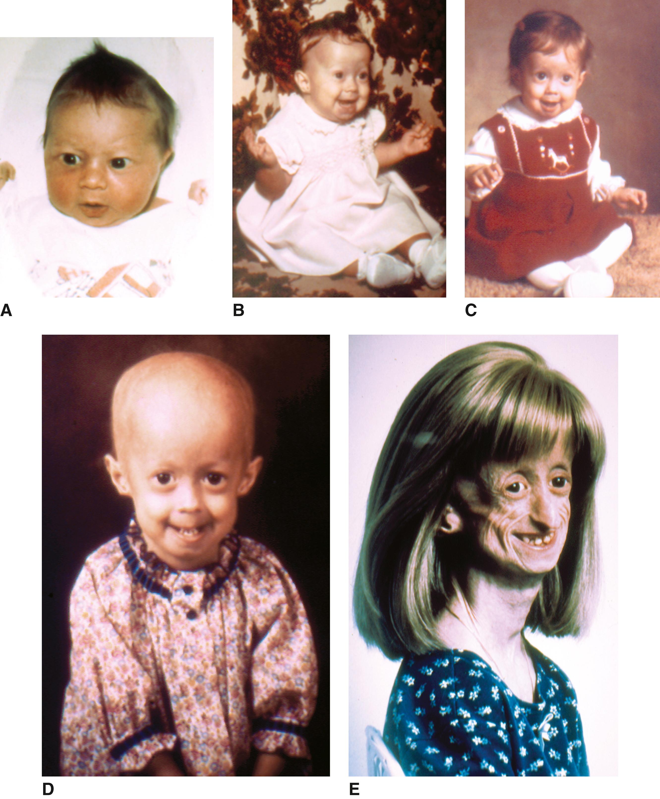 FIGURE 2, A–E, An affected child beginning in the neonatal period demonstrates the progression of the phenotype.