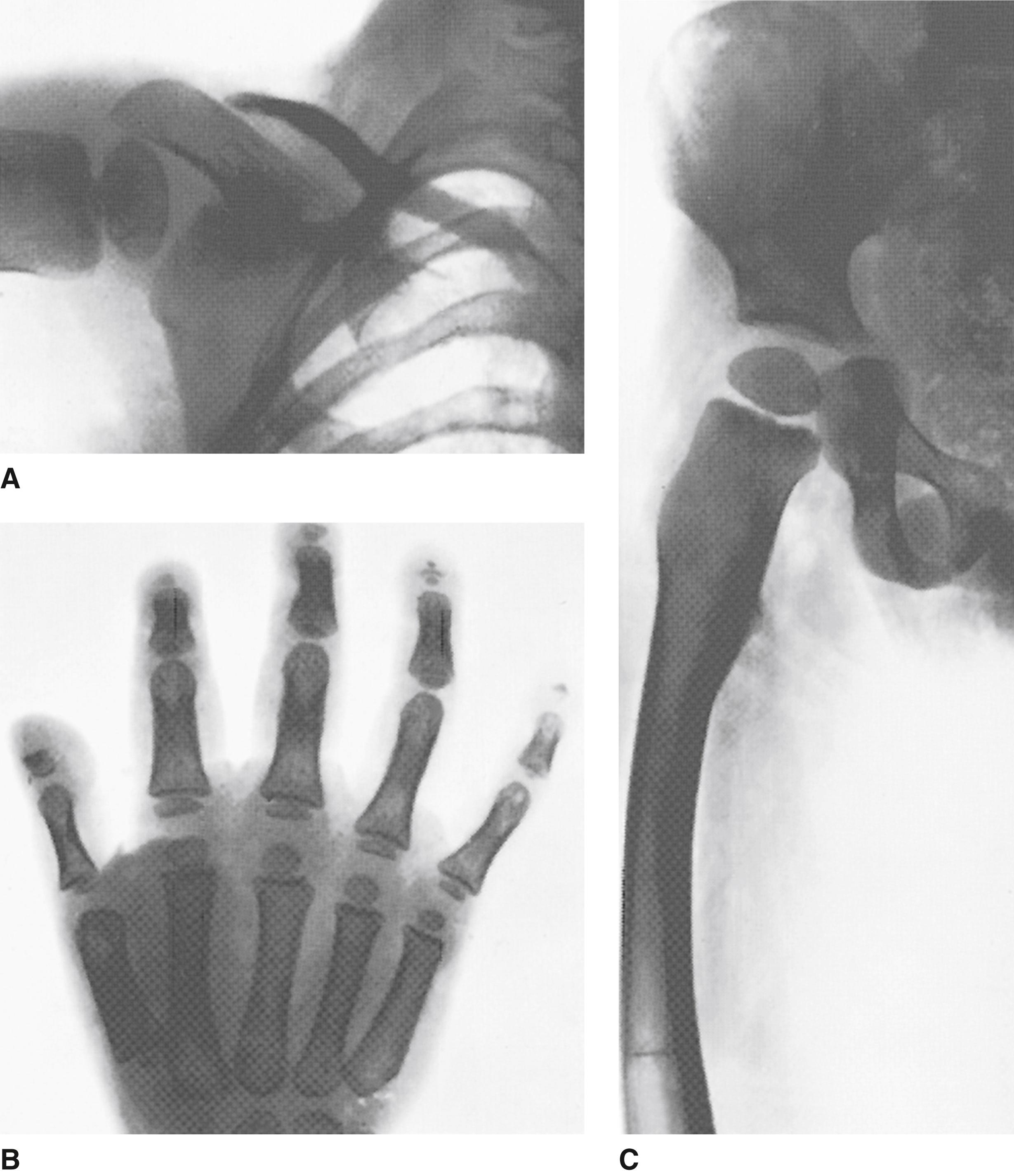FIGURE 3, A–C, Radiographs of a 3-year-old child show loss of outer clavicle, distal phalanges, and straight femur.