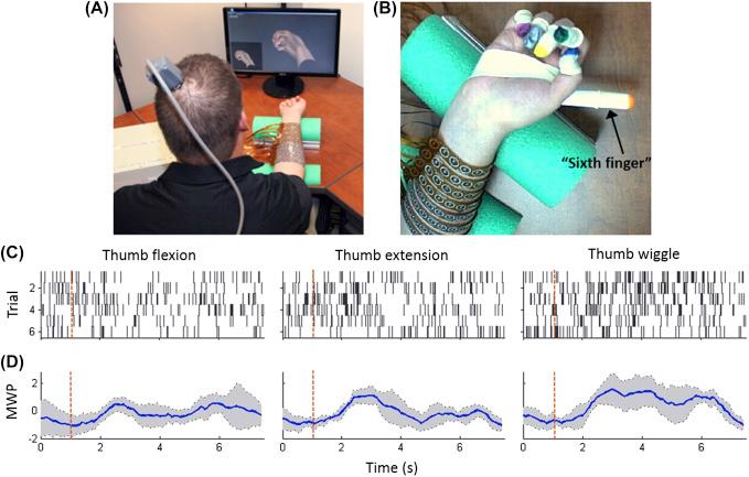 Figure 131.2, Rhythmic movement achieved by a paralyzed study participant using an electronic neural bypass. (A) Experimental setup; (B) participant’s hand and colored markers for movement tracking camera; (C) raster of unit activity for multiple trials; and (D) mean wavelet power for multiunit activity averaged across trials.