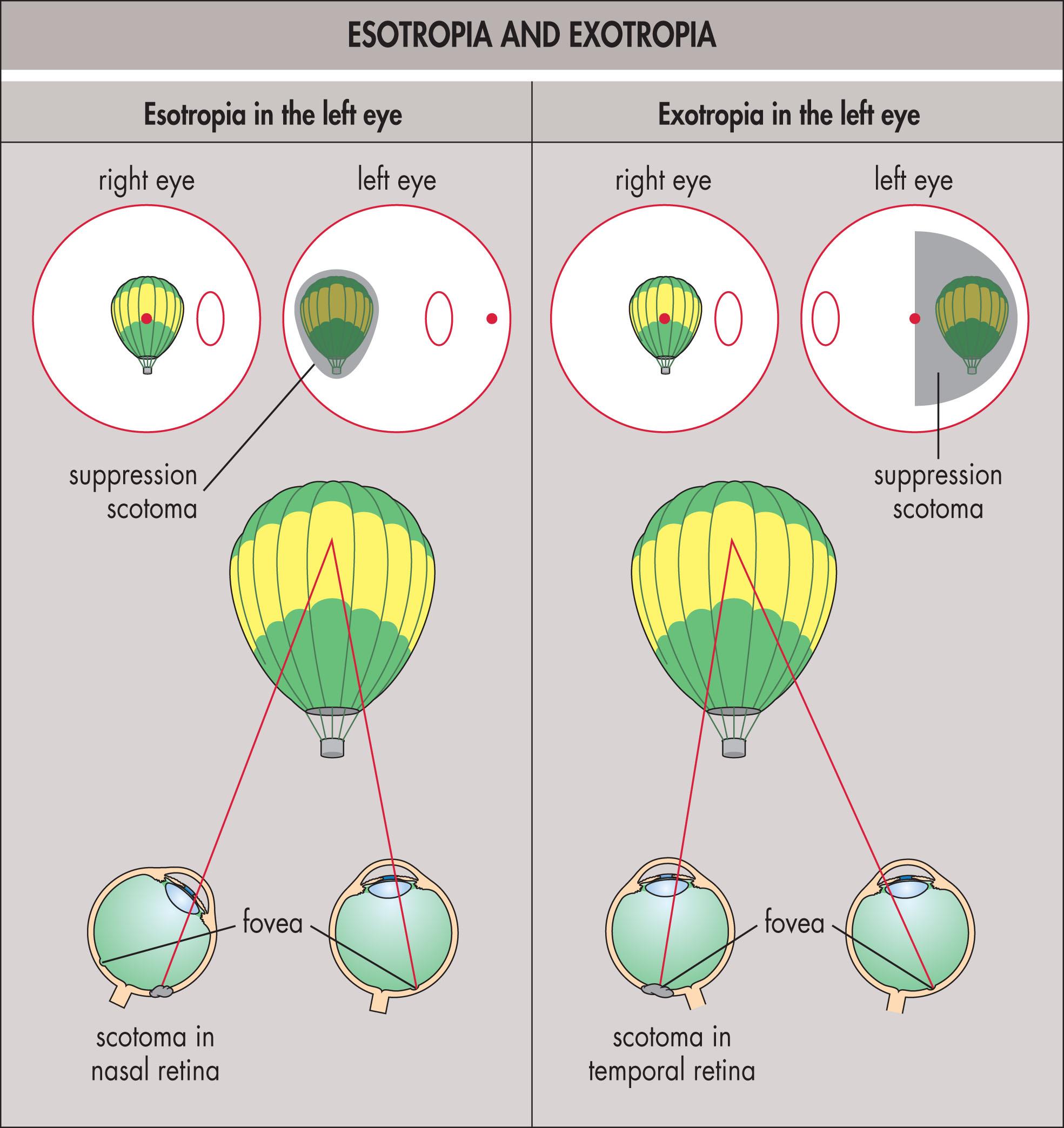 Fig. 11.5.2, Esotropia and Exotropia.