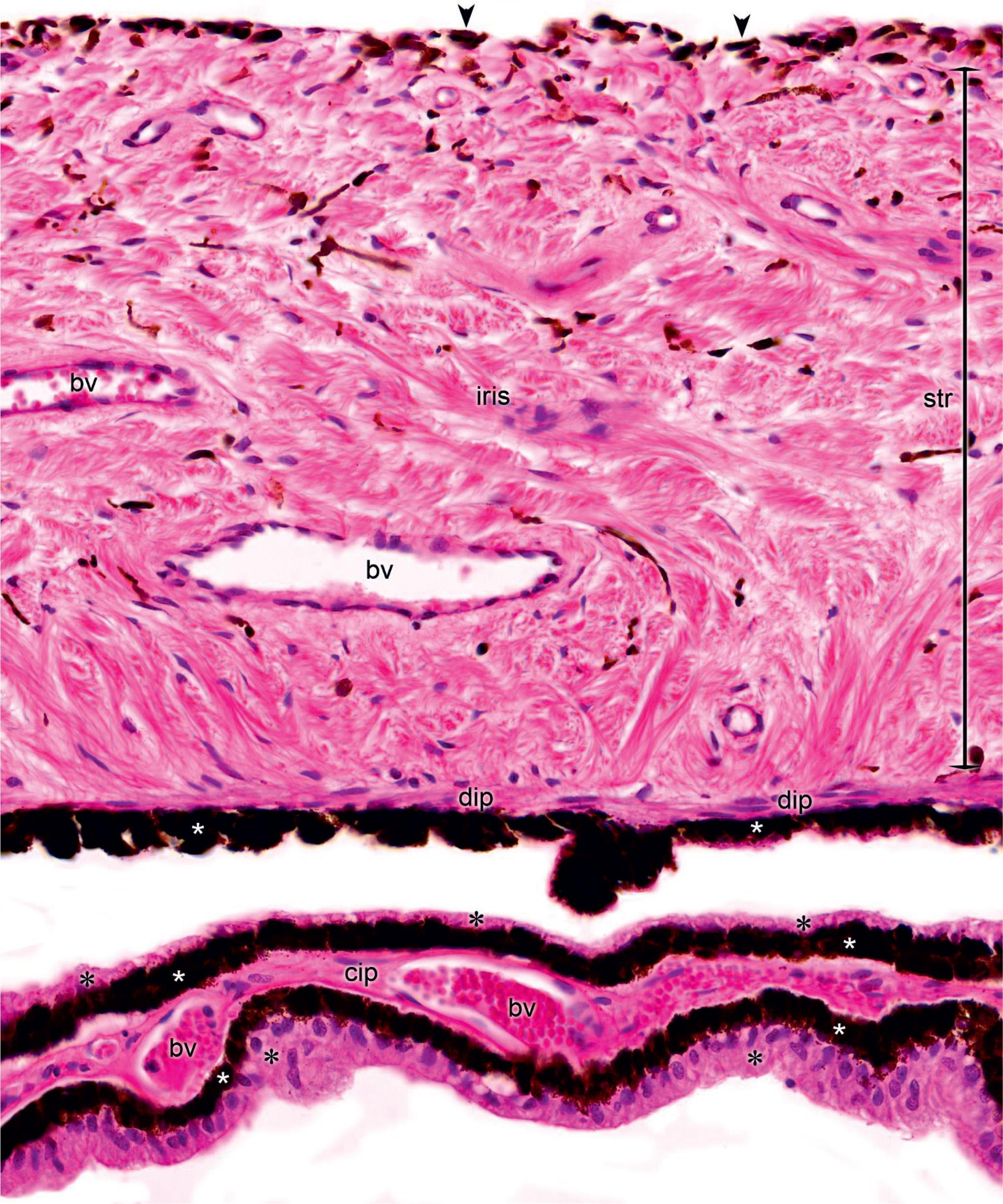 Figure 323, Iris with a ciliary process (cip). Iris is composed of vascularized stroma (str) formed by fibroblast and melanocytes with blood vessels. The stroma of the iris is covered posteriorly by melanin-containing, myoepithelial cells forming the dilator pupillae muscle (dip) and a layer of extremely pigmented epithelial cells (five-pointed asterisks) that also lines the ciliary processes. Anteriorly, iris is lined with a discontinuous layer of melanocytes (arrowheads) and fibroblasts. Ciliary processes (cip) contain vessels (bv) and they are lined with an inner pigmented (five-pointed asterisks) and an outer nonpigmented layer of cuboidal cells (six-pointed asterisks); the latter is the continuation of the non-photosensitive portion of the retina and produces the aqueous humor.