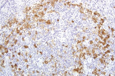 Fig. 28.11, Lymph node stained for S100 protein: the illustration shows a paracortical nodule with an abundant population of polydendritic dendritic cells (DCs) that tend to cluster in a ring around the periphery of the paracortical tissue. This classic distribution of DCs is best seen at moderate magnification. DC may also be encountered in the lymph node sinuses and less abundantly in B-cell areas. In addition to their distribution, the presence of multiple complex dendritic processes, relatively small size, and lack of a prominent S100 positive nucleus allows separation of these cells from melanoma cells. Additionally, DC do not express MART-1/Melan-A or HMB-45. In some SN, DC may lose their dendrites, and this may present more of a diagnostic challenge.