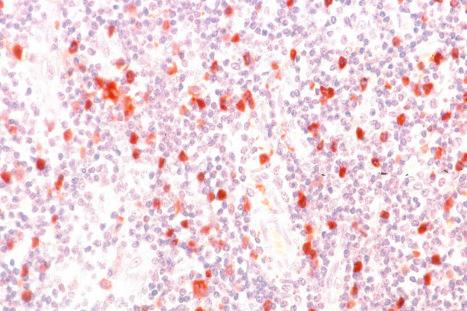 Fig. 28.12, Poorly dendritic and nondendritic DC in a sentinel node: reduced expression of dendrites by DC is viewed as evidence that they are down-regulated by tumor-induced immune suppression. Nondendritic DC are recognized by their scattered distribution in nodal paracortex and sinuses and their characteristic immunophenotype: S100 positive, MART-1 and HMB-45 negative.