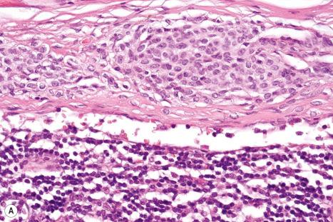 Fig. 28.13, Capsular nevus: ( A ) shows a nevus that is clearly confined to a slightly expanded nodal capsule (H&E). Nevus cells are smaller than most melanoma cells, have limited cytoplasm, usually show only traces of cytoplasmic melanin, and may resemble large lymphocytes. Their nuclei are bland and lack large nucleoli or mitoses. ( B ) A capsular nevus stained for S100 demonstrating epitope in nuclei and cytoplasm. ( C ) A capsular nevus stained for MART-1/Melan-A demonstrating epitope confined to the cytoplasm. ( D ) A capsular nevus stained for HMB-45. The great majority of nevus cells do not express HMB-45, although occasional cells may show a trace of epitope in the cytoplasm.