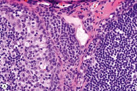 Fig. 28.14, Trabecular nevus cells: ( A ) shows a column of nevus cells located in a nodal trabeculum and flanked by a peritrabecular sinus and lymphoid parenchyma; ( B ) shows the same trabecular nevus stained for S100 and again flanked by a peritrabecular sinus and lymphoid parenchyma. The S100 positive cells in the peritrabecular sinus and parenchyma are dendritic cells.