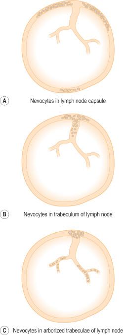 Fig. 28.15, Diagram demonstrating the relationship of capsular and trabecular nevus cells to the lymph node: note that the nevus cells can also be present in fine arborizations of the nodal trabecular frame work (which may only become visible with special stains for collagen and reticulin). In the absence of special staining, it may be incorrectly assumed that such cells are free within the nodal parenchyma and they may be incorrectly interpreted as melanoma metastases.