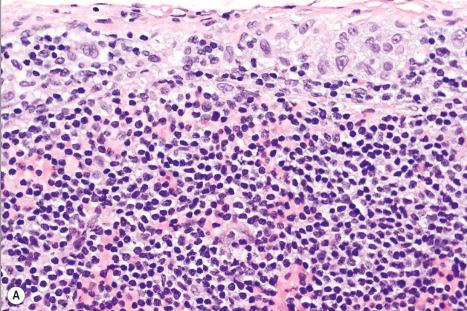 Fig. 28.16, Subcapsular sinus melanoma metastases: ( A ) this shows a ribbon of melanoma cells sandwiched between the nodal capsule and the nodal parenchyma (H&E). ( B ) There is a small collection of S100-positive melanoma cells immediately deep to the capsule. Note that deeper in the node there are S100 positive dendritic cells that lack the prominent nuclear staining by S100 that is seen in the melanoma cells. Most of these are poorly dendritic, but some have well-developed dendritic processes. ( C ) Detail of the subcapsular melanoma in ( B ); ( D ) shows subcapsular melanoma expressing HMB-45. This lesion also expressed MART-1/Melan-A with a similar cytoplasmic pattern of staining (not shown).