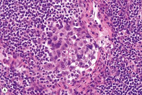 Fig. 28.17, Parenchymal melanoma metastases: these panels show a metastasis of melanoma located deep in the nodal parenchyma. ( A ) While visible in an H&E-stained section, the fact that ( B ) the amelanotic lesion expresses S100 protein, ( C ) MART-1/Melan-A, and ( D ) HMB-45 confirms that it is a melanoma.