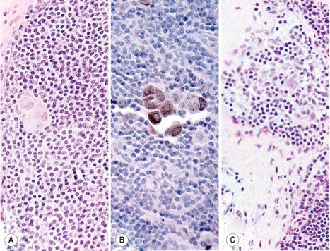 Fig. 28.18, Care must be taken to avoid the overinterpretation of nodal macrophages as melanoma cells. In panel ( A ), relatively large epithelioid macrophages are scattered among lymphocytes in a subcapsular position. These cells were negative for S100, MART-1/Melan-A, and HMB-45. Panel ( B ) shows a collection of relatively large macrophages containing abundant coarsely granular melanin (melanophages). These cells were negative for S100, MART-1/Melan-A, and HMB-45. Panel ( C ) shows a small granuloma-like collection of epithelioid macrophages. These cells were negative for S100.