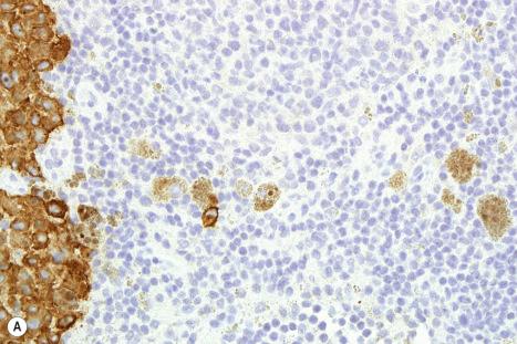 Fig. 28.19, Nodal macrophages: a further problem with nodal macrophages is that they may ingest fragments of melanosomes that express melanoma-associated epitopes from disrupted melanocytic cells and react positively in immunohistochemical studies: ( A ) shows a MART-1/Melan-A-stained section with metastatic melanoma at the left and toward the right scattered macrophages that contain MART-1/Melan-A positive granules; ( B ) shows a collection of macrophages that contain coarse HMB-45 positive granules.