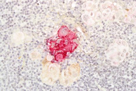 Fig. 28.20, Melanoma: this small collection of melanoma cells stains positively for HMB-45 and is highlighted by the red chromogen aminoethylcarbazole. Note the granuloma-like collections of melanin-containing macrophages that surround these cells. Traces of AEC-highlighted, HMB-45 positive material are present in some of the macrophages.