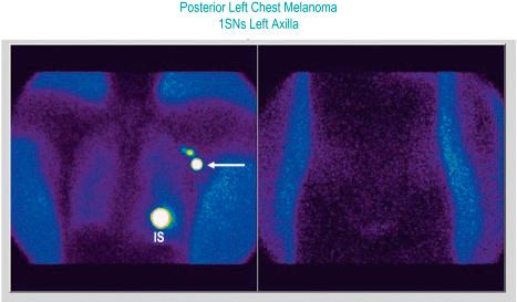 Fig. 28.2, Identification of a left axillary sentinel node (SN) by lymphoscintigraphy in a patient with a primary melanoma on the left mid back: two 20 MBq, 0.1 mL injections of 99mTc antimony sulfide were made on either side of a small excision biopsy site ( IS ). On the left is an anterior view of the shoulders, axilla, and chest showing the prominent SN ( white arrow ) and limited spread of tracer to a second-tier node above the SN. On the right is an anterior view of the pelvis showing no evidence of drainage to groin nodes.