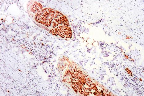 Fig. 28.21, Perinodal nerve: the Schwann cells are stained with an antibody to S100. While the neural nature of such structures is usually (as in this case) readily apparent, there may occasionally be a problem in distinguishing neural structures from melanoma cells in a lymphatic or free in the tissue. This type of problem is most likely to occur when the nerves are intranodal or if the tissue section is thick or from poorly fixed material. Nerves stain negatively with antibodies to MART-1/Melan-A and HMB-45.