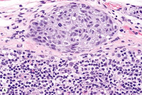 Fig. 28.22, Metastatic tumor in afferent lymphatics: ( A ) melanoma in the intracapsular segment of an afferent lymphatic of a sentinel lymph node (H&E); ( B ) MART-1/Melan-A. In the presence of these appearances, the sentinel node should be reported as positive.