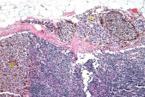 Fig. 28.24, Extracapsular extension of melanoma from a sentinel lymph node: tumor extends through the capsule and into the adjacent perinodal fat.