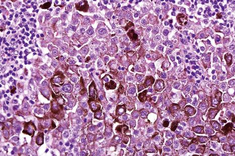 Fig. 28.25, Nodal metastatic melanoma: the great majority of cells in this illustration are melanoma cells, but a minority have coarse granules of melanin and are regarded as melanin-containing macrophages (melanophages).