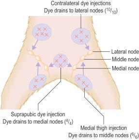 Fig. 28.3, Animal study: this demonstrates that dye injected in specific areas of the skin drains reliably to predictable lymph nodes. Dye injected in the lower lateral abdomen, the suprapubic area, and the upper medial thigh passed reliably to the lateral, medial, and middle lymph nodes, respectively.