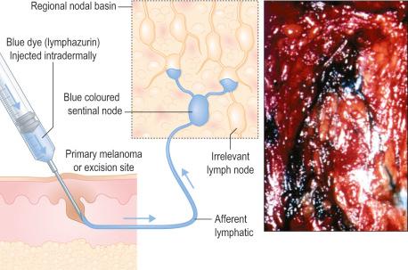 Fig. 28.4, Diagram and photograph of the sentinel node (SN) technique as originally applied: blue dye (lymphazurin) is injected intradermally around the primary melanoma or biopsy site. The surgeon then explores the lymph node area identified by prior lymphoscintigraphy as the lymph drainage destination from the site of the primary tumor. Blue-colored afferent lymphatics ( lower two-thirds of the right panel ) are identified and followed to the blue-colored sentinel node ( upper mid area of the right panel ). Note that the SN is not necessarily the node that is anatomically closest to the primary site.