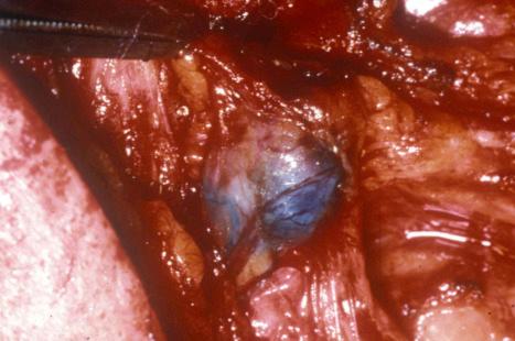 Fig. 28.5, Lymphazurin-stained blue sentinel node in situ. Persistence of visible dye is unusual when the specimen arrives in the pathology department.