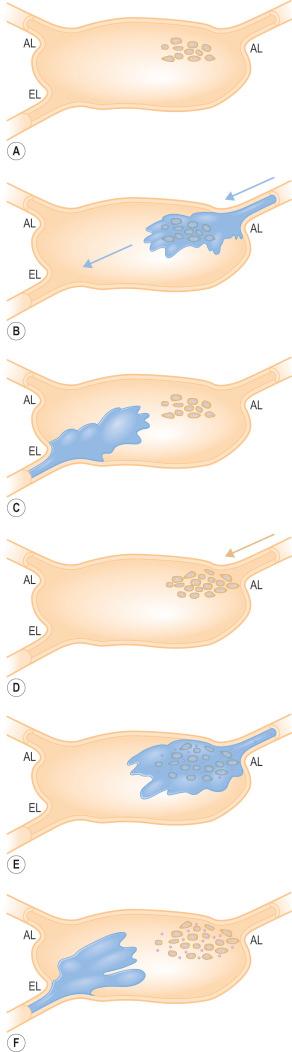 Fig. 28.7, Use of carbon particles to confirm the sentinel status of a lymph node and focus the search for tumor cells: ( A ) the upper three parts show the dynamics of passage of blue dye through an SN that contains a small focus of tumor cells. ( B and C ) The blue dye enters via the afferent lymphatic (AL) from the area of the primary tumor (via the same lymphatic that delivered the tumor cells) and rapidly passes through the lymph node to exit via the efferent lymphatic (EL). ( D ) The lower three parts show the identical sequence, but with carbon particles added to the blue dye. In contrast to the blue dye: ( E and F ) the carbon particles persist in the node, confirming its sentinel status and indicate the point of entry of the afferent lymphatic where tumor cells are most likely to be detected; ( B ) carbon particles free and within macrophages in a lymph node that received lymph from the site of a black tattoo.