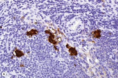 Fig. 28.10, Single melanoma cells immunohistochemistry: detected by their expression of ( A ) S100 protein; ( B ) MART-1/Melan-A; and ( C ) HMB-45. In the illustration of the HMB-45-stained section, there is a granular macrophage below and to the right of the central melanoma cells.